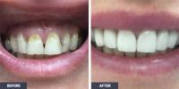 Implant Dentures image 3